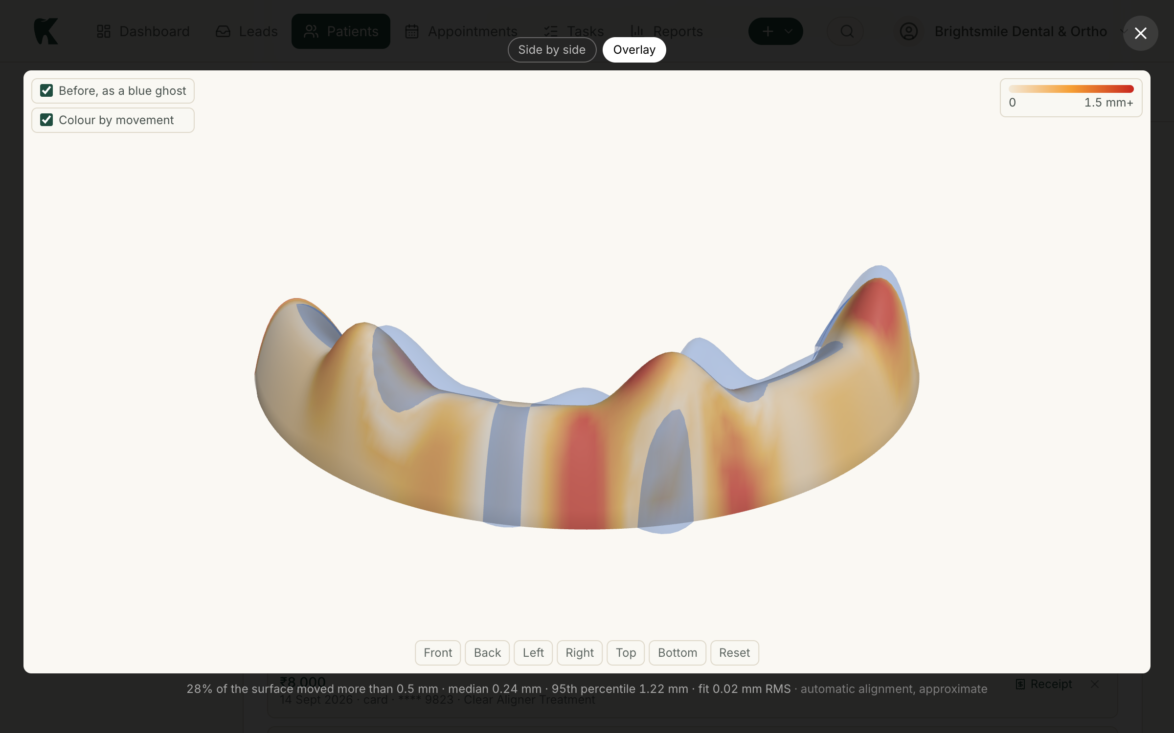 Kythro laying two intraoral scans of the same upper arch over each other, the earlier one as a blue ghost and the later one coloured by how far each tooth moved